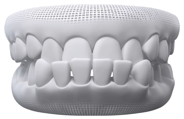 Underbite dental model