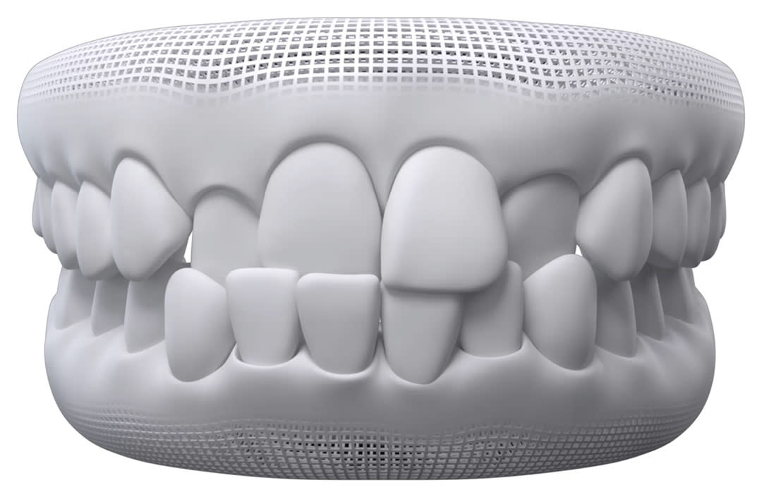 Crossbite dental model