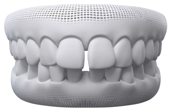 Gaps Between Teeth dental model