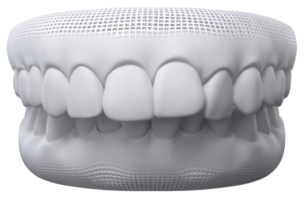 Overbite dental model