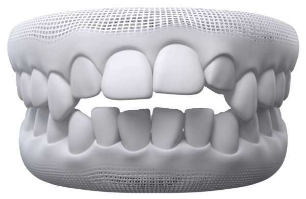 Open Bite dental model