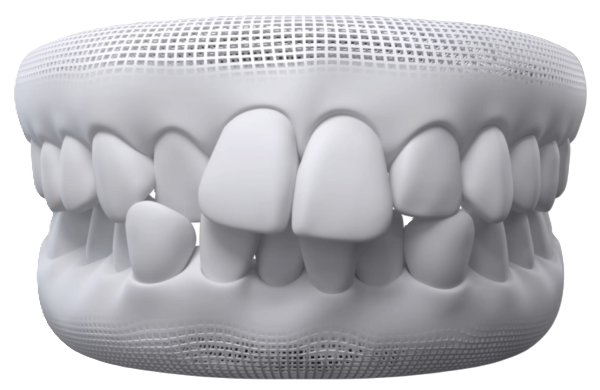 Crowded Teeth dental model